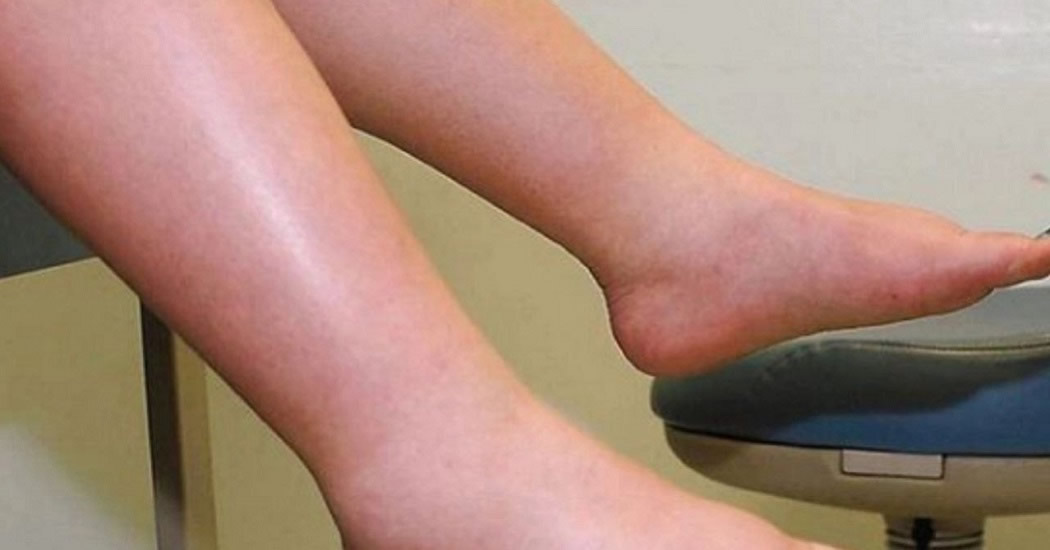 Уролог назвал опухшие ноги сигналом к запущенной форме рака