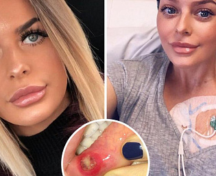  Болячки во рту девушки оказались смертельно опасной болезнью