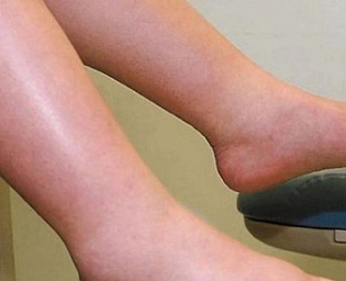  Уролог назвал опухшие ноги сигналом к запущенной форме рака
